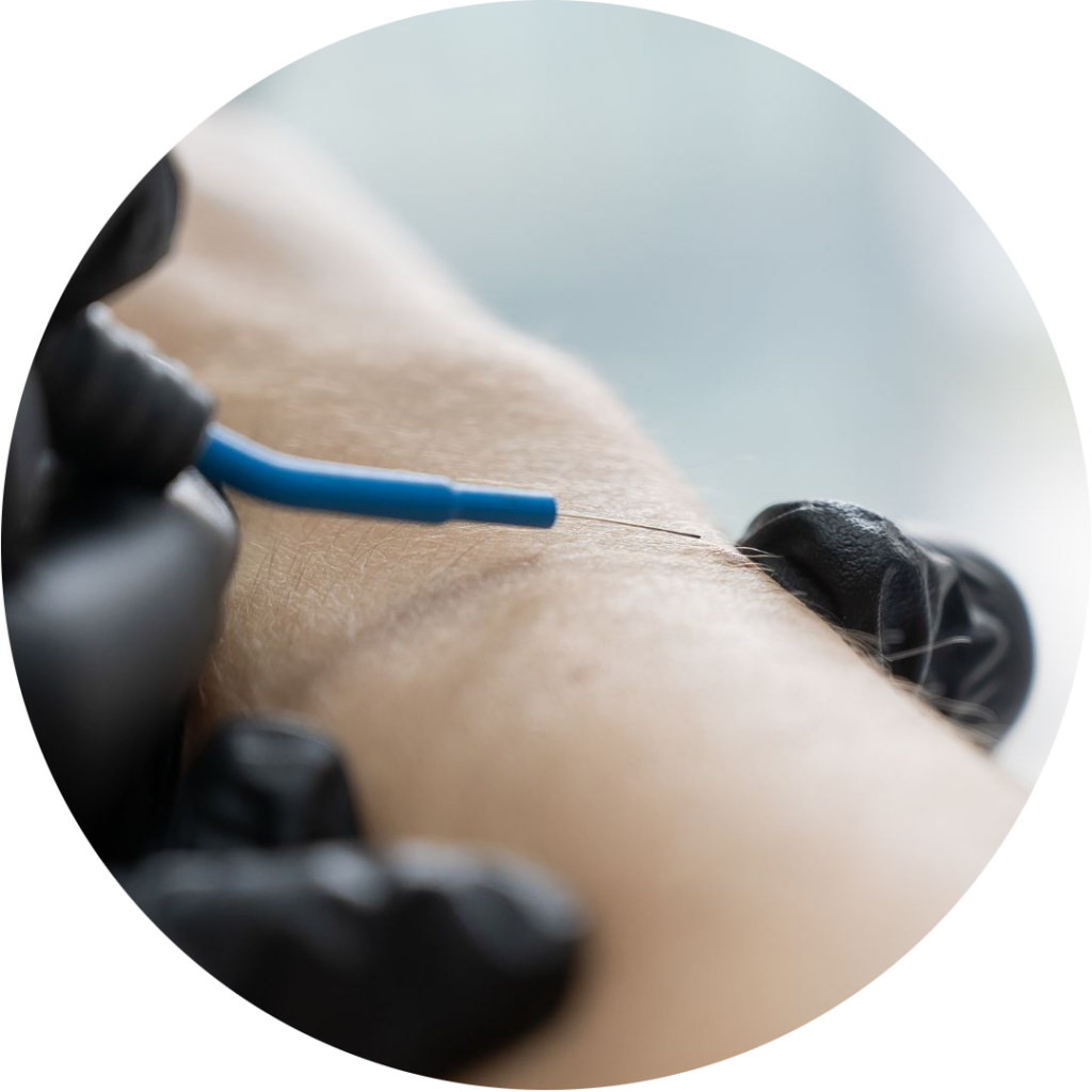 una persona che si fa un tatuaggio sul braccio